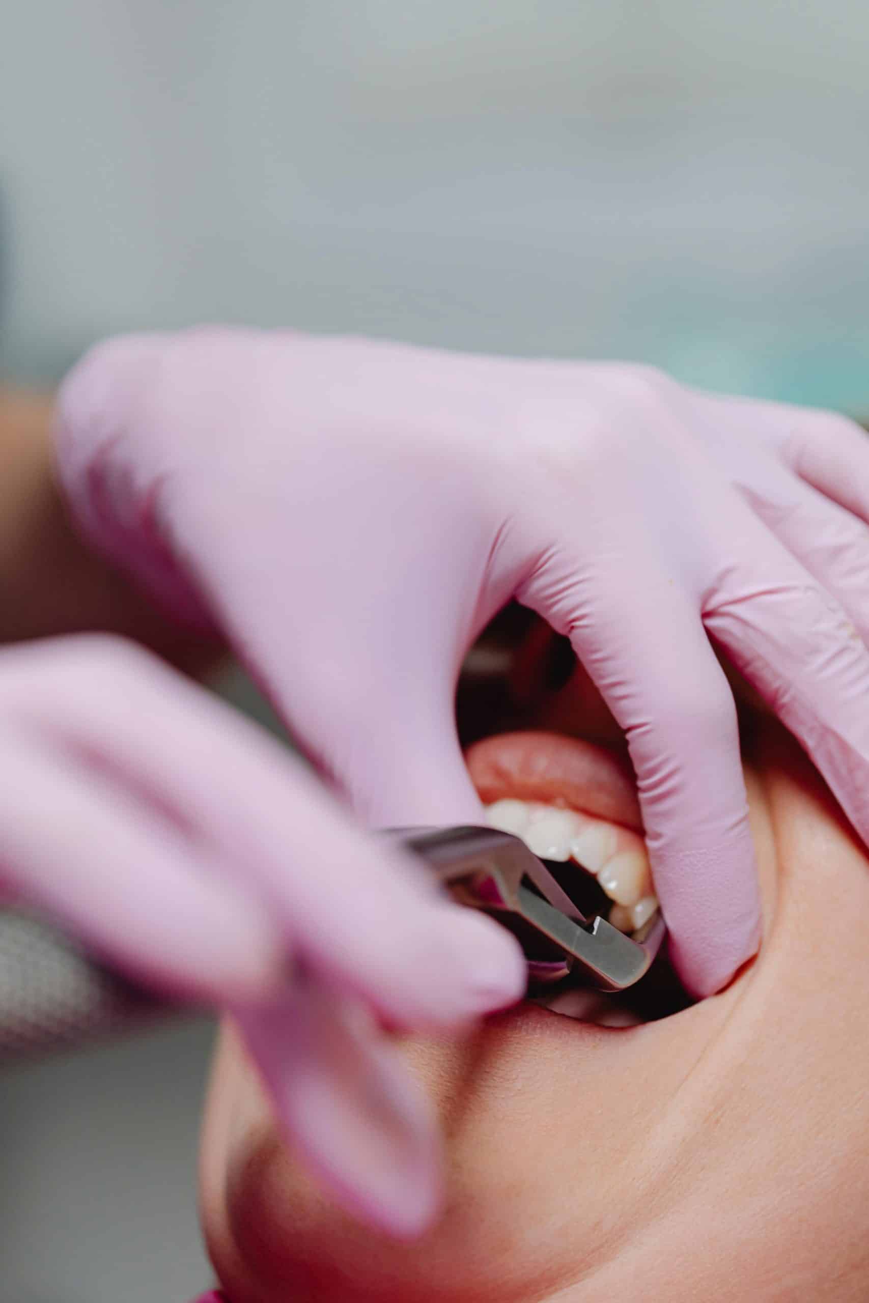 tooth extraction from sage dental
